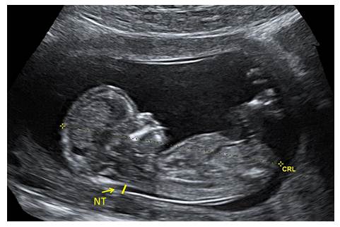 5a- nuchal transluscency
